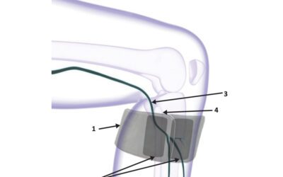 Studie-Ny behandlingsmetod mot RLS symtom med elektrostimulering